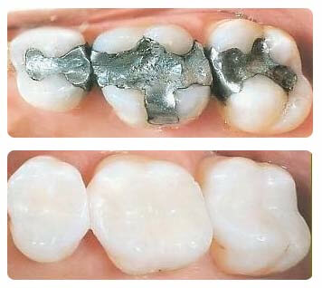 Alexandria VA teeth before and after replacing amalgam fillings with white composite fillings