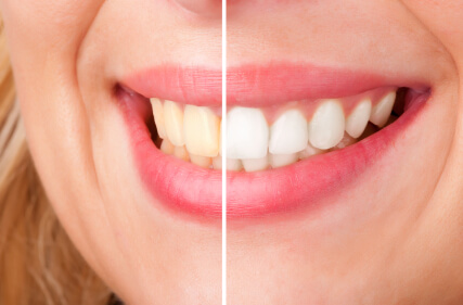 Alexandria VA teeth before and after whitening