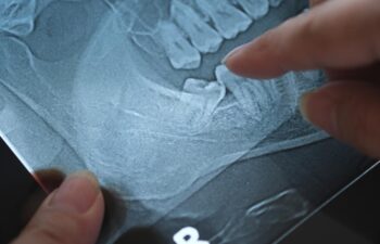 Panoramic x-ray image of teeth and mouth with wisdom teeth