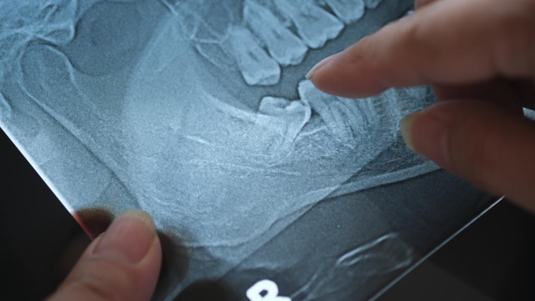Panoramic x-ray image of teeth and mouth with wisdom teeth