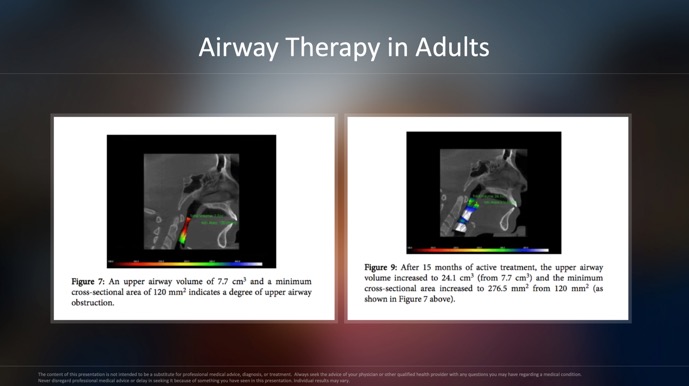 Airway-Therapy-in-Adults