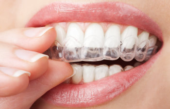 Why Invisalign is a Wise Choice for Orthodontic Treatment with Gum Disease Alexandria, VA