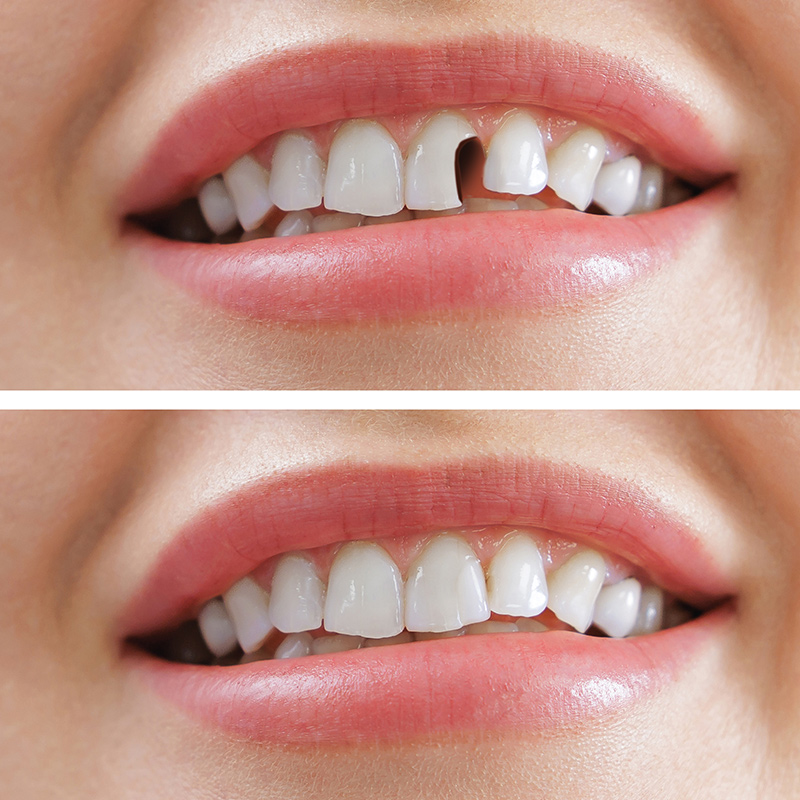 Chipped tooth repair