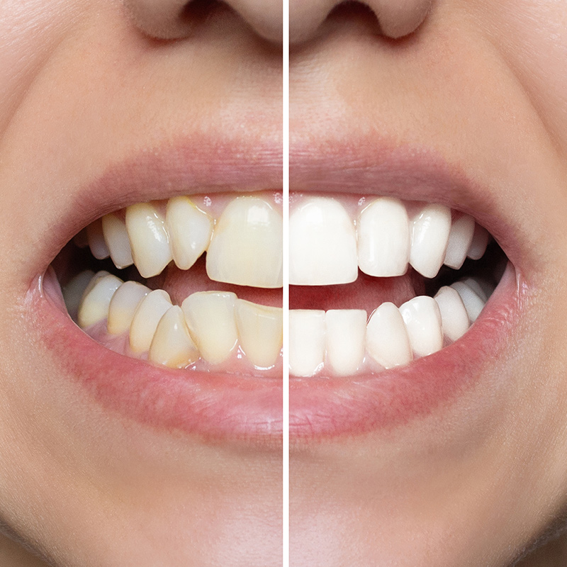 Dentalveneers holistic dentistry