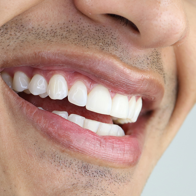 Teethwhitening holistic dentistry